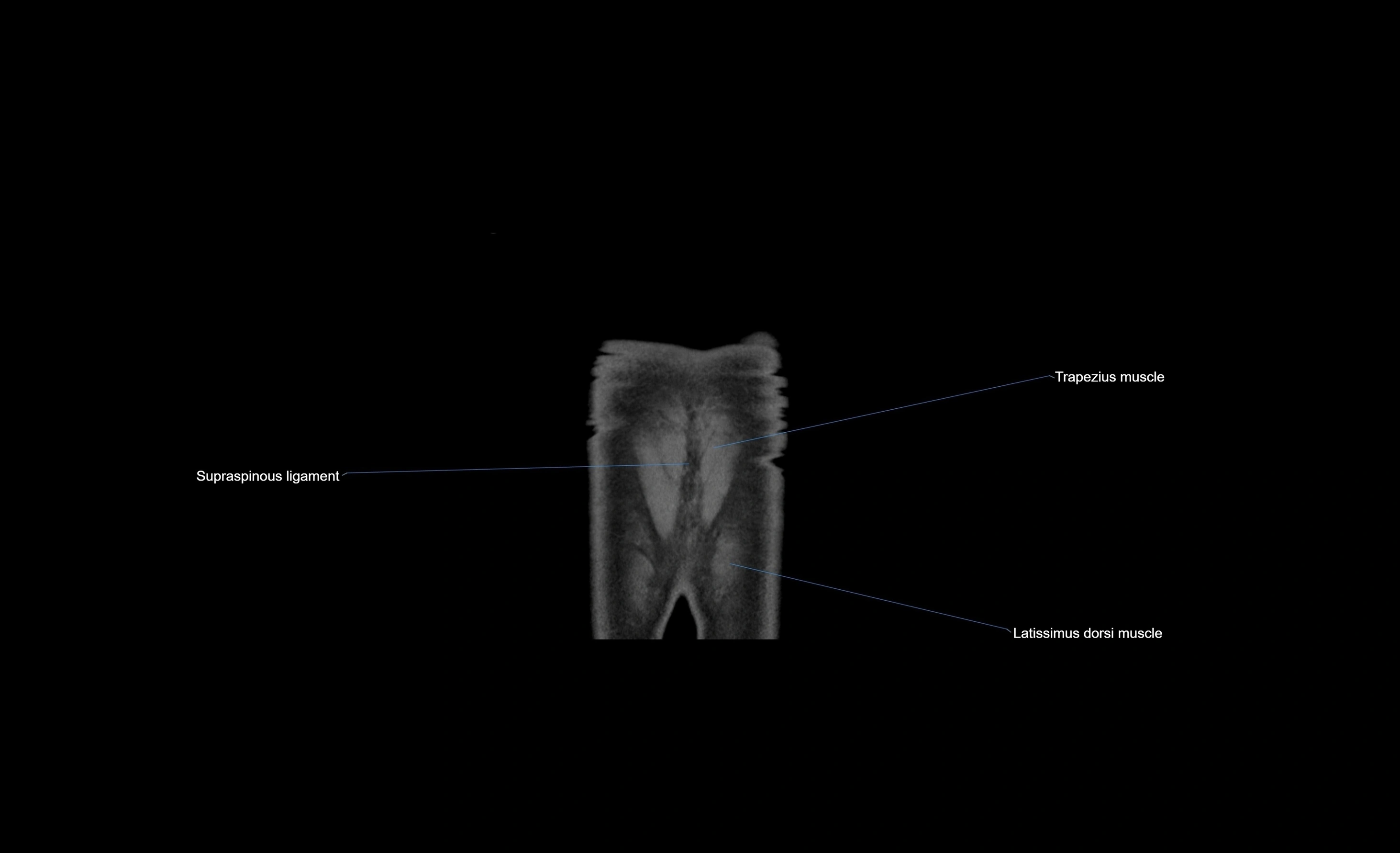 CT chest (thorax) labelled coronal cross sectional anatomy radiology image-00003.webp